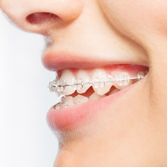 clear fixed braces orthodontic treatment