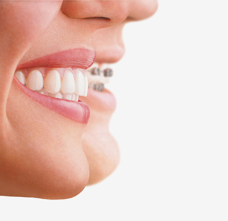 benefits of Invisalign