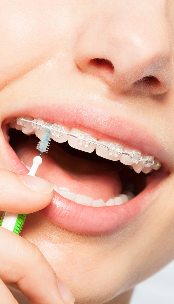 looking after fixed braces