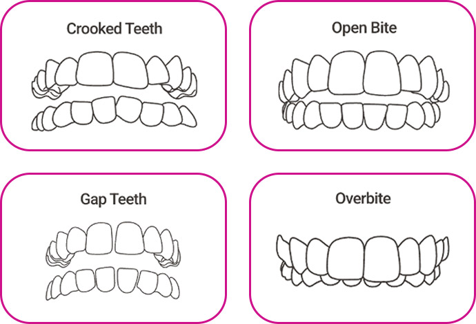 adult orthodontic problem with misaligned teeth