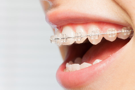 ceramic fixed braces