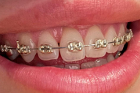 champagne‑colored fixed braces