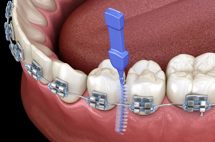 how fixed braces work for teeth alignment