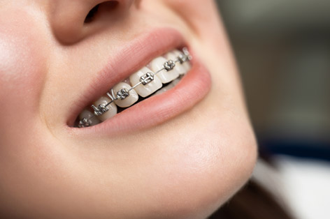 metal fixed braces for orthodontic treatment