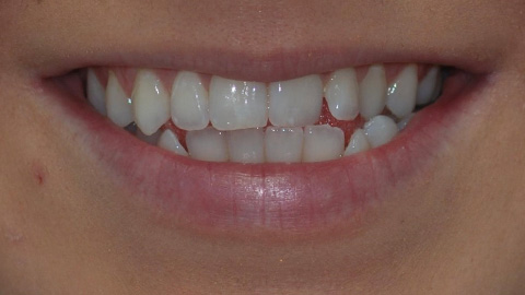 Before