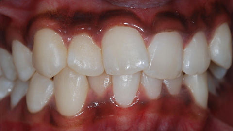 Before